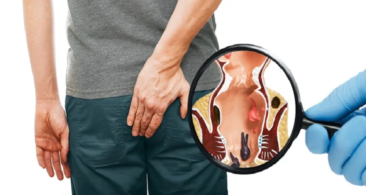 باندلیگاسیون هموروئید